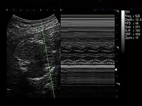 M-режим, анатомический M-режим (AMM)