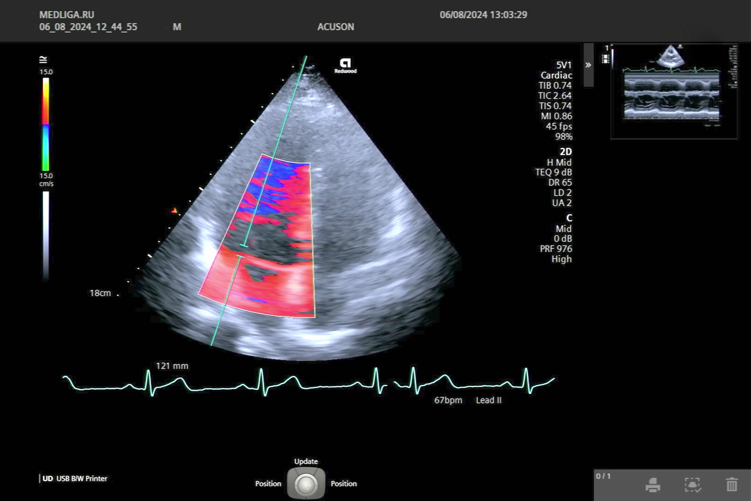 Плановая эхокардиография на Siemens Acuson Redwood