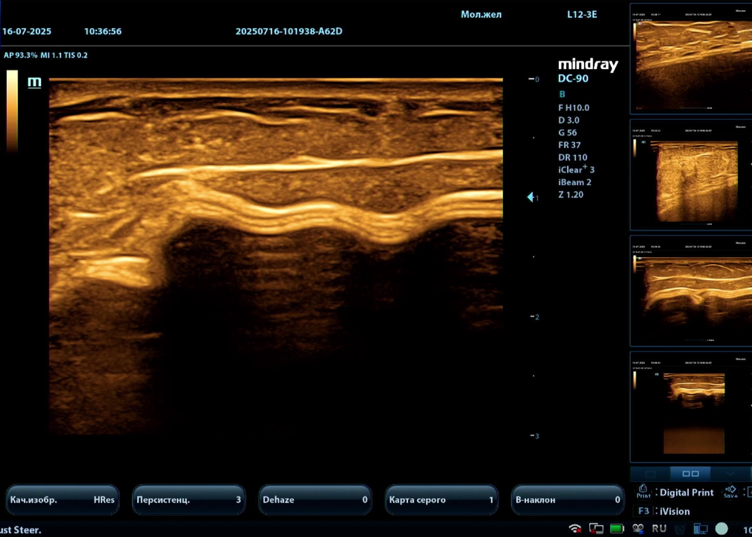 Мастер-класс по УЗИ молочных желез с имплантами на Mindray DC-90