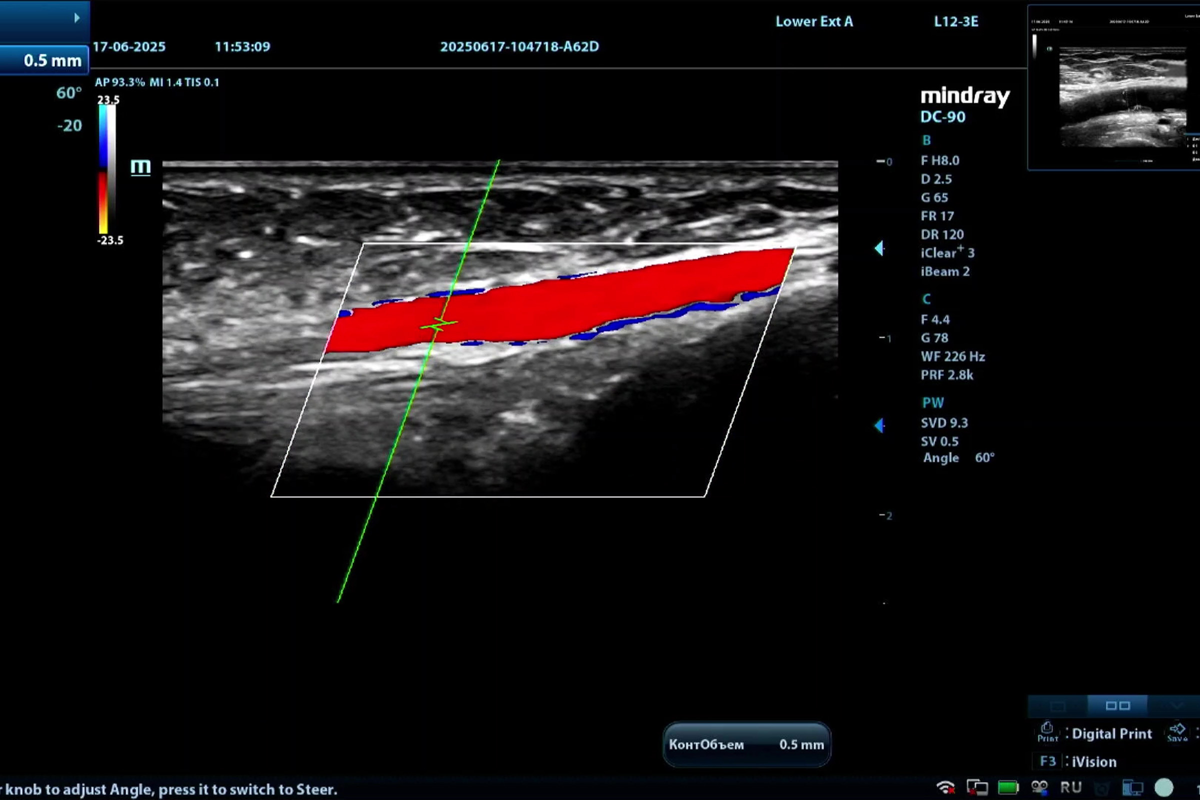 Исследование артерий нижних конечностей на Mindray DC-90