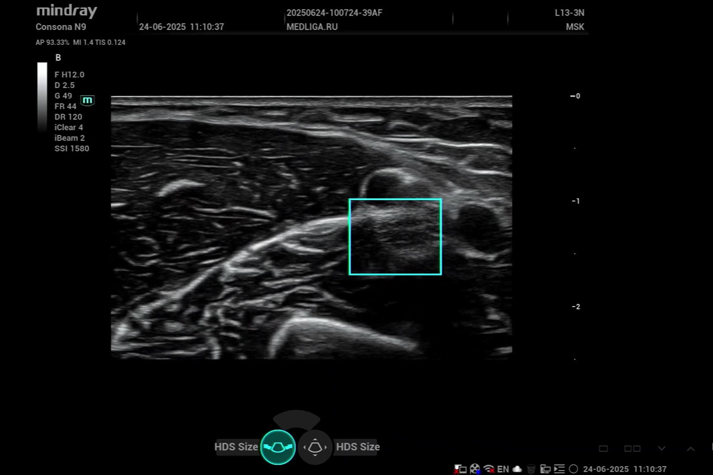 Настройка изображения на Mindray Consona N9: УЗИ суставов, мышц, нервов